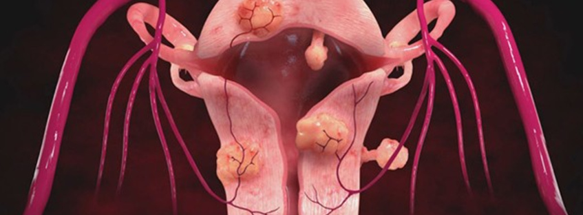 Интерстициальная миома